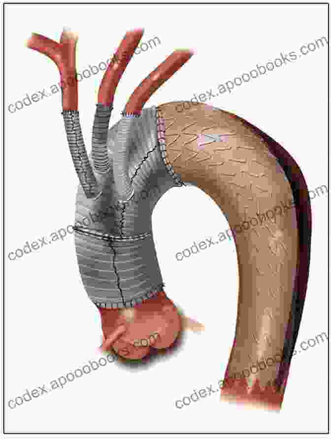 Aortic Dissection Surgical Repair Emergency Vascular Surgery: A Practical Guide