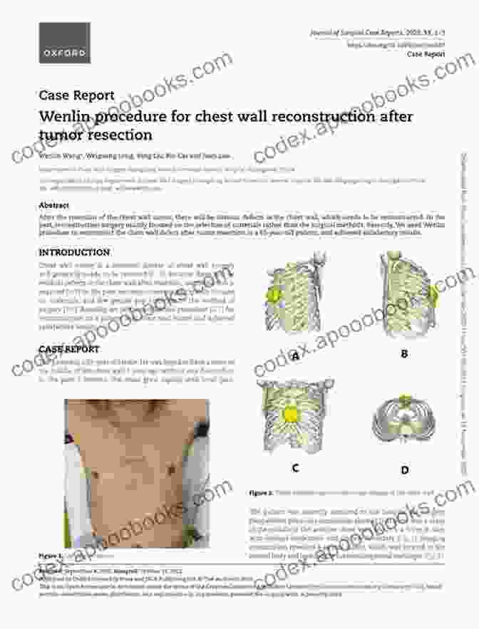 Chest Wall Reconstruction Procedure Plastic Surgery: Volume 4: Trunk And Lower Extremity