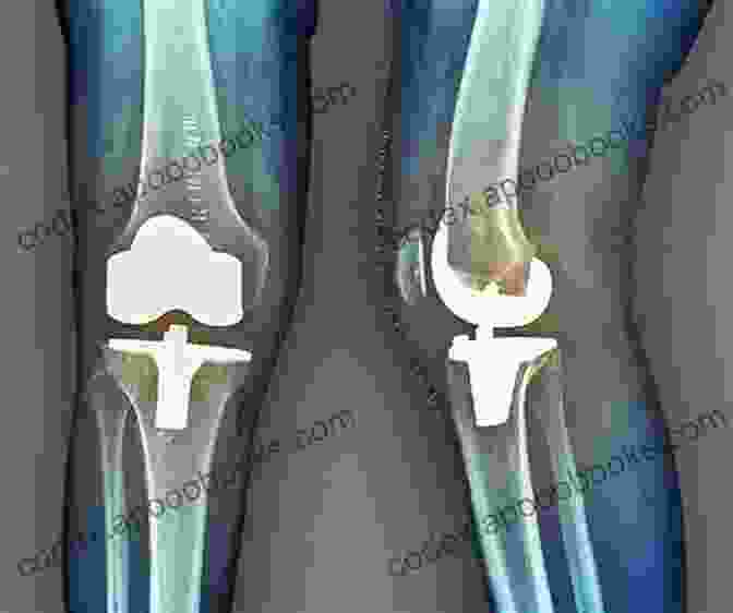 Diagram Of A Knee Replacement Surgery White Paper On Joint Replacement: Status Of Hip And Knee Arthroplasty Care In Germany