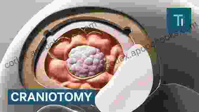 Intraoperative Photograph Demonstrating A Surgical Procedure On A Pediatric Brain Tumor. Pediatric Neurosurgery (Neurosurgical Operative Atlas)