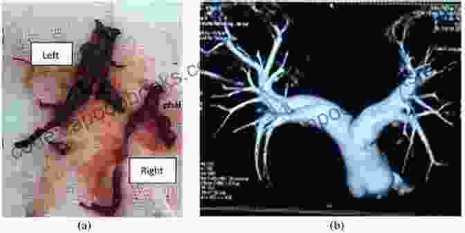 Pulmonary Embolectomy Emergency Vascular Surgery: A Practical Guide