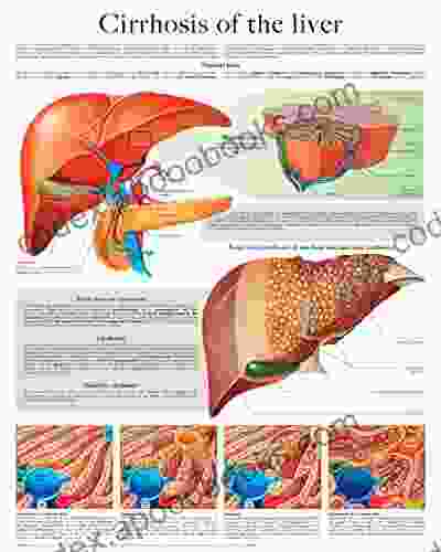 Cirrhosis of the liver e chart: Full illustrated